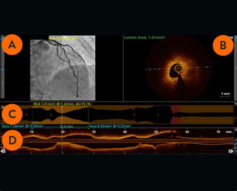 Optical Coherence Tomography Oct Intravascular Imaging Abbott
