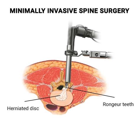 Minimally Invasive Spine Surgery Brooklyn Downtown Pain Physicians
