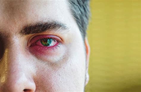 Eye Inflammation All About Vision