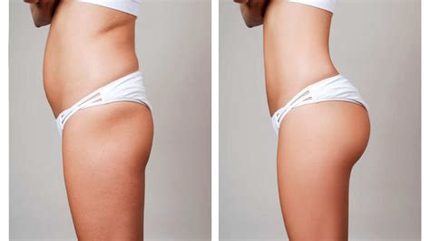 Why The Brazilian Butt Lift Is The Deadliest Cosmetic Surgery Procedure What The Risks Are And