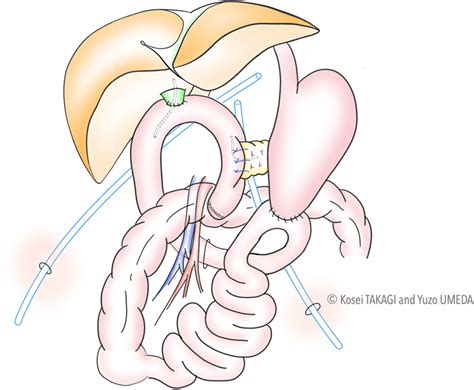 Overview Of Robotic Pancreatoduodenectomy Download Scientific Diagram