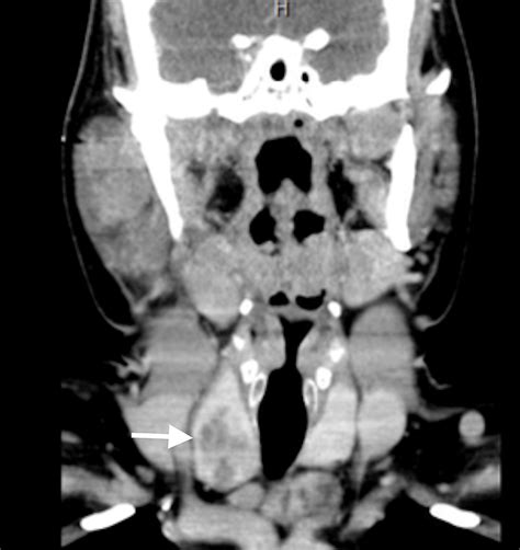 Cureus Tumors Of Atypical Carcinoma Of The Parotid Gland And