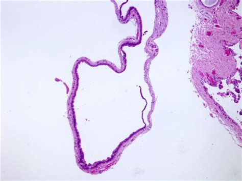 Pathology Outlines Hidrocystoma