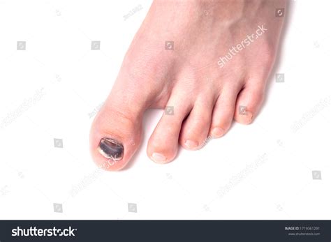 Injured Blue Toenail Broken Finger Foot Stock Photo 1719361291