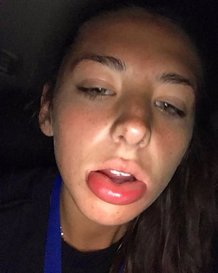 The Second Face Of A Bee Sting Lip Fashion Shocking Photos Of People