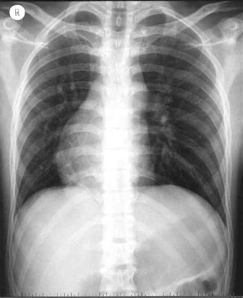 Dextrocardia X Ray Wikidoc
