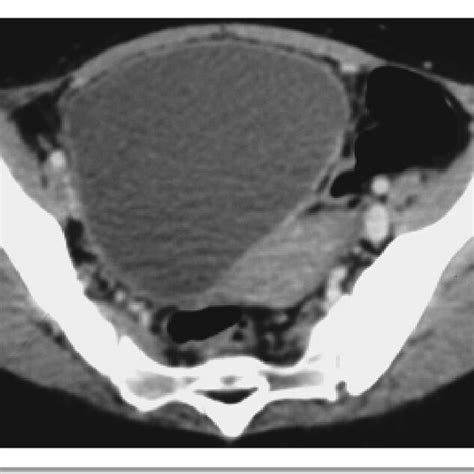 pelvic ct scan in axial section right latero uterine cystic mass with download scientific