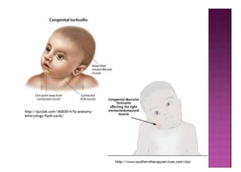Congenital Muscular Torticollis And Positional Plagiocephaly Flashcards Quizlet