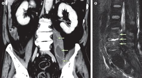 Primary Iliopsoas Abscess In A Diabetic Patient The Lancet Infectious