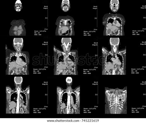 Ct Scan Abdomenchest Front View Body Stock Photo Edit Now 745221619