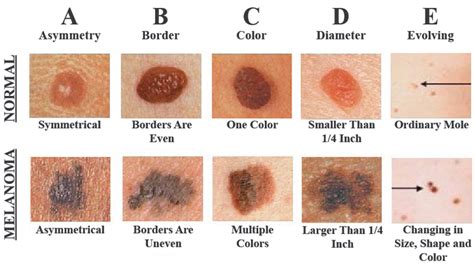 55 The Basics Of Skin Cancer Chemistry Libretexts
