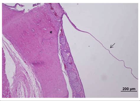 In The Control Group Normal Tympanic Membrane Structures Were Observed