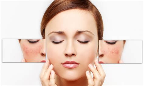 Reducing Facial Redness With Laser Treament Beijing Starlight Sandt