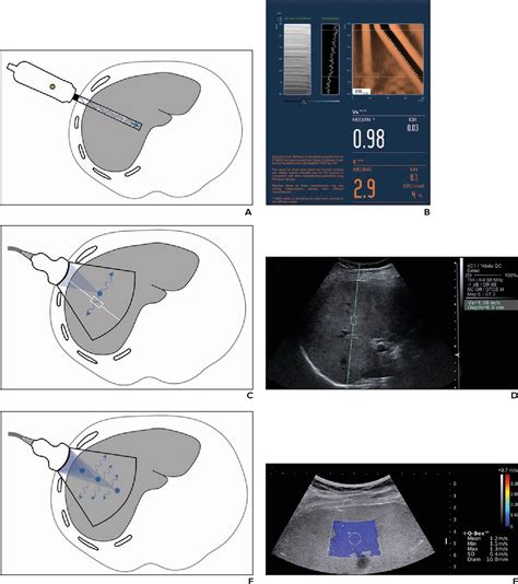 Figure 2 From Ultrasound Elastography And Mr Elastography For Assessing