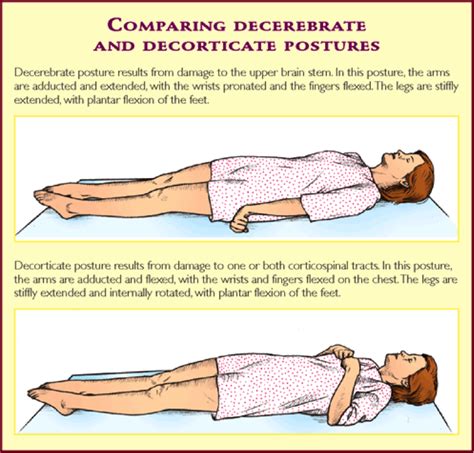 DECORTICACION Y DESCEREBRACION PDF La rigidez de descerebración es un estado de contractura hipertónica generalizada de la musculatura esquelética, con descerebracion y decorticacion.
