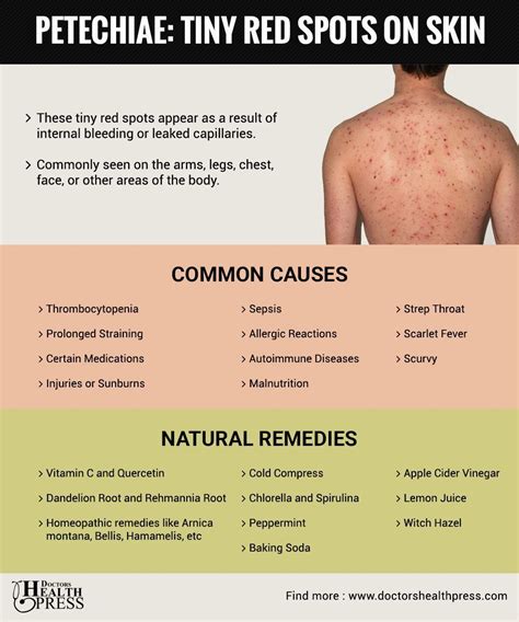 Petechiae May Be A Sign Of A Number Of Conditions But To Help