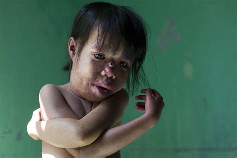 Agent Orange Victims Then And Now In 24 Disturbing Photos