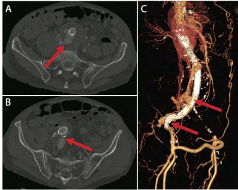 A Computed Tomography Angiogram Showing Persistent Aortocaval Fistula