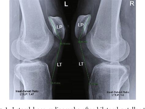 Figure 1 From Simultaneous Bilateral Rupture Of The Patellar Tendon And