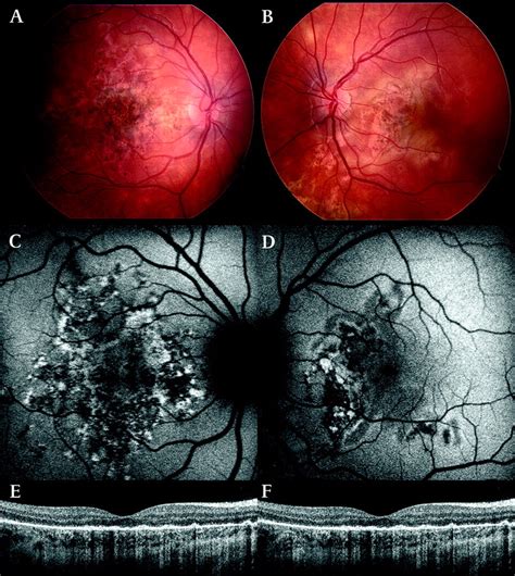 Acute Posterior Multifocal Placoid Pigment Epitheliopathy Following