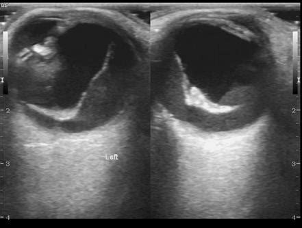 Posterior Vitreous Detachment Radiology Reference Article