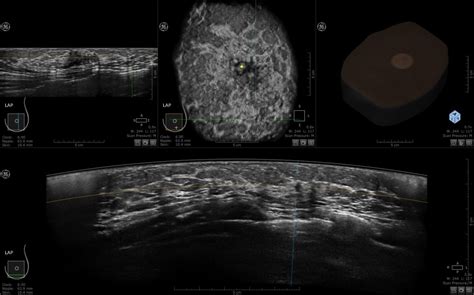 3 D Automated Breast Ultrasound Abus Διαγνωστική Μαστογραφία
