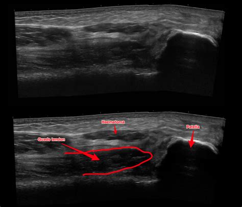 Distal Biceps Rupture Ultrasound