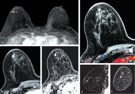 Breast Mri Overview Radiology Key