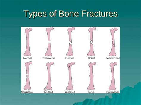 Compound Fracture Impacted Fracture Greenstick Fracture Ppt