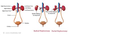 Nephrectomy Types Risks And Complications