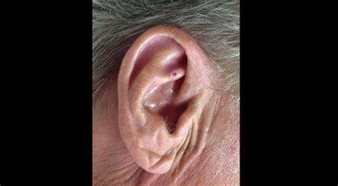 Derm Dx Painful Lesion Of The Ear Clinical Advisor