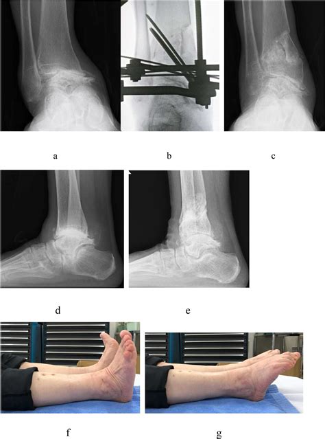 Distal Tibial Oblique Osteotomy For Reconstruction Of Ankle Joint