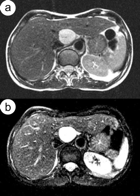 Hepatic Hemangioma Moderately A And Heavily B T2 Weighted Mr