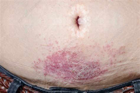 Contact Dermatitis From Belt Buckle Stock Image C0238973 Science
