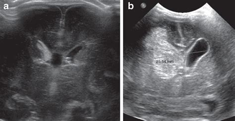Intraventricular Hemorrhage Ultrasound