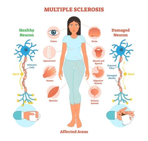 Multiple Sclerosis Risk Factors