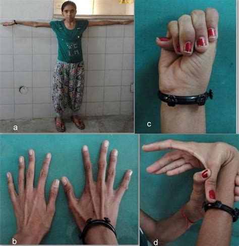 Marfan Syndrome Bmj Case Reports