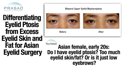 the difference between eyelid ptosis and raising an asian eyelid crease youtube