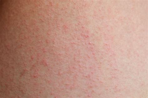 Dermatitis Rash Pictures Symptoms And Pictures
