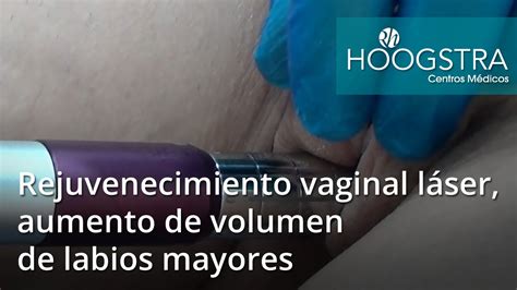 Rejuvenecimiento Vaginal L Ser Aumento De Volumen De Labios Mayores