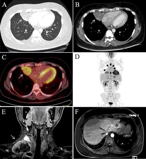 Ct Pet And Mri Scans Showed A Primary Lesion In The Right Lung And