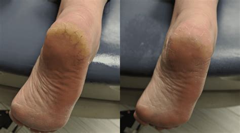 Dry Cracked Heels Bruyere Foot Specialists