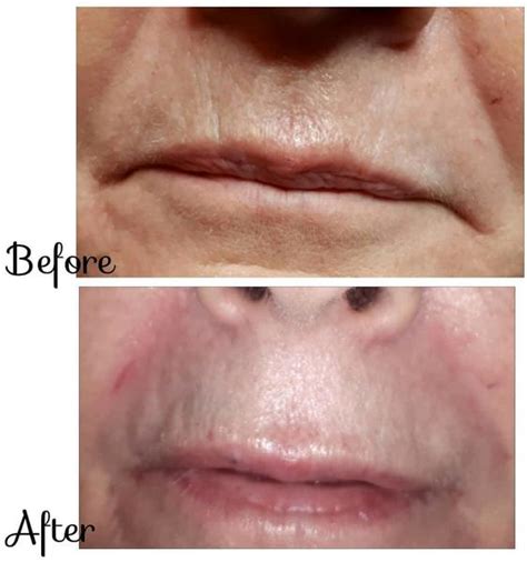 Juvederm Before And After Photos Nasolabial Folds 1 Facial