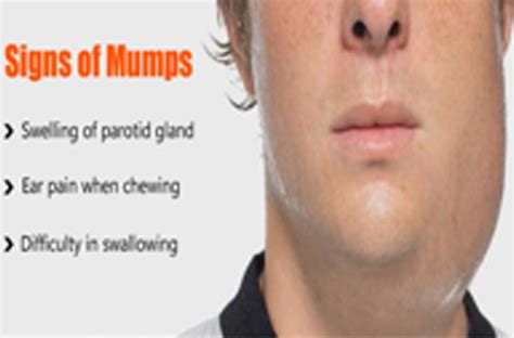 Parotid Gland Swelling Mumps