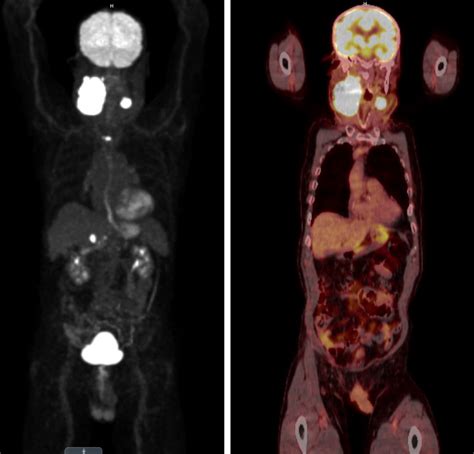 Petct In The Management Of Lymphomas Stagingre Staging And Treatment