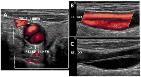Chemical Shift Imaging Of A Spontaneous Internal Carotid Artery My