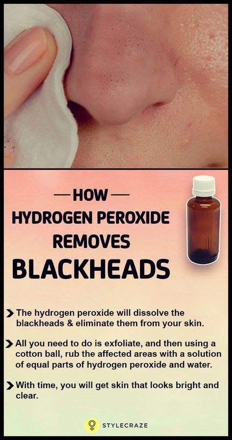 How To Use Hydrogen Peroxide To Remove Blackheads Cystic Acne