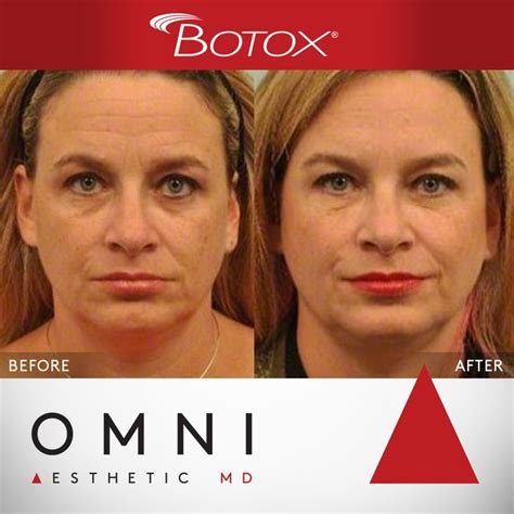 Patient Received Botox Injections To Her Upper And Lower Facial Area