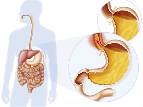 Reflux Gastrique D Finition Sympt Mes Traitement Sciences Et Avenir