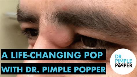 A Life Changing Pop With Dr Pimple Popper